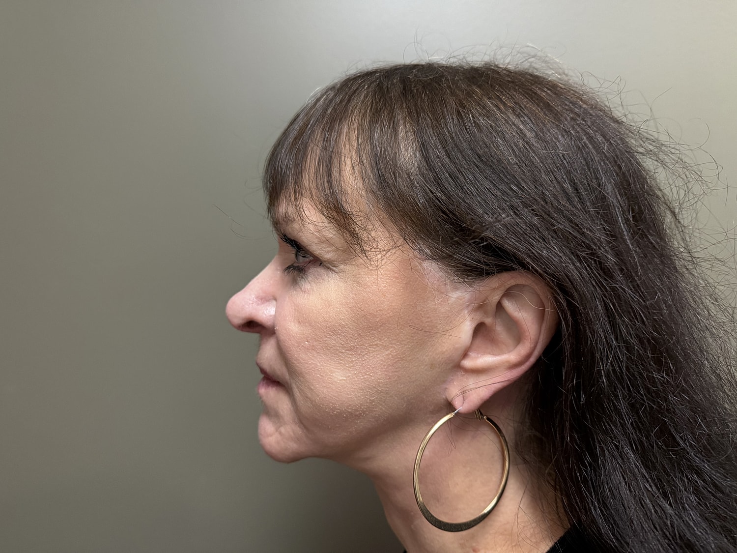 Facelift Before & After