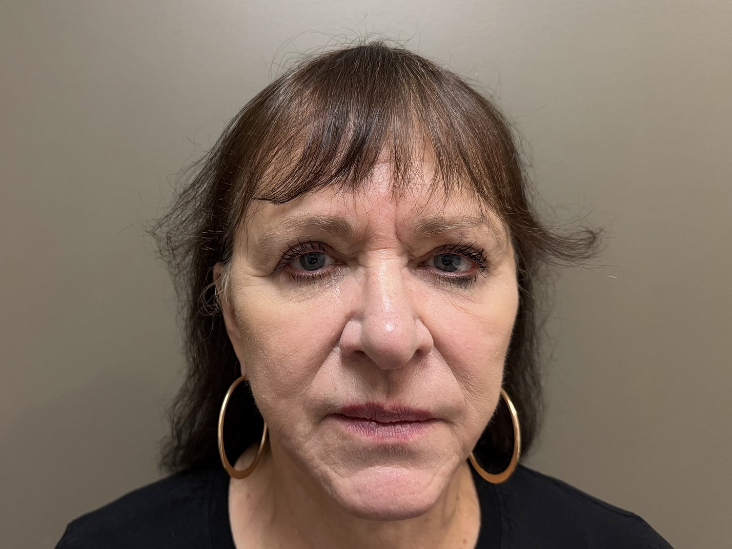 Facelift Before & After