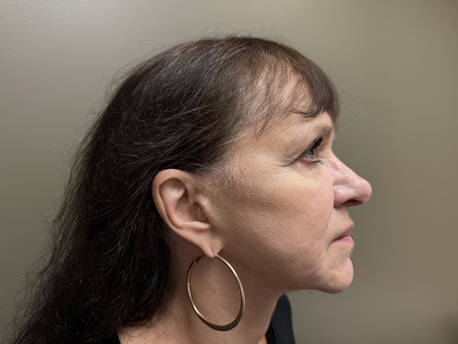 Facelift Before & After