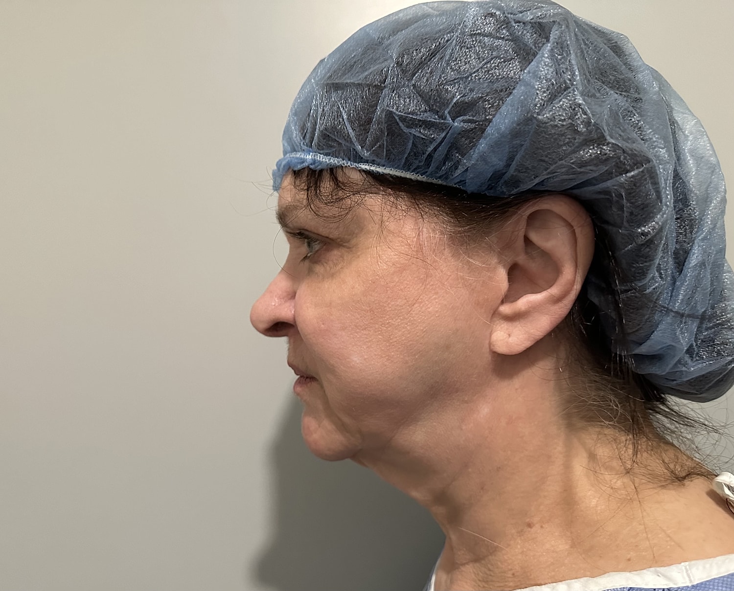 Facelift Before & After