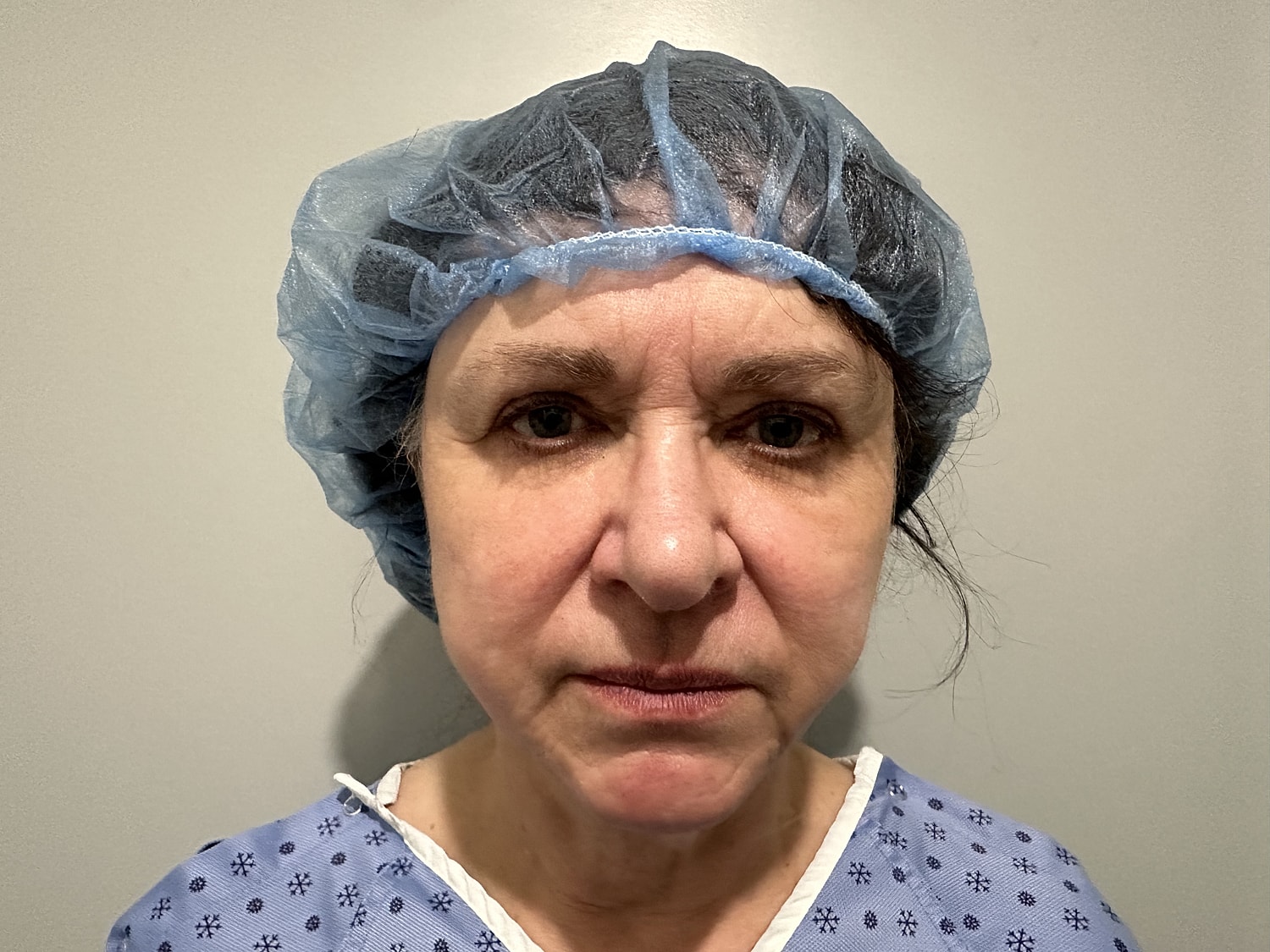 Facelift Before & After