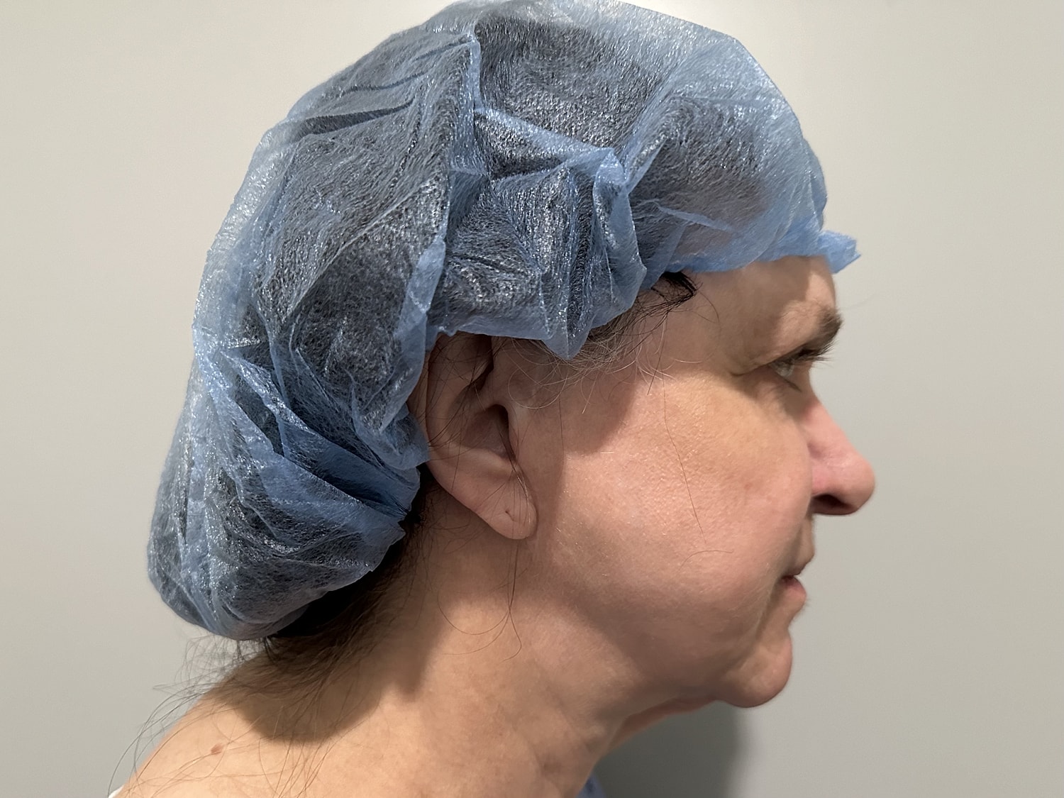 Facelift Before & After