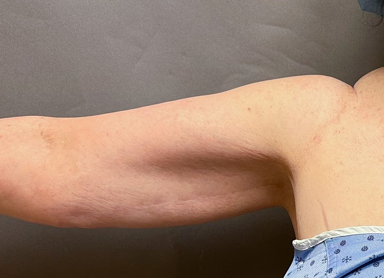 Brachioplasty Before & After