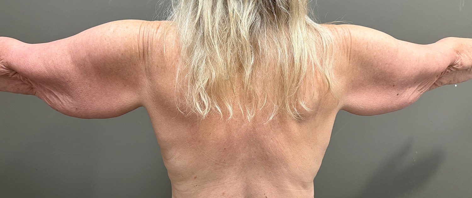 Brachioplasty Before & After