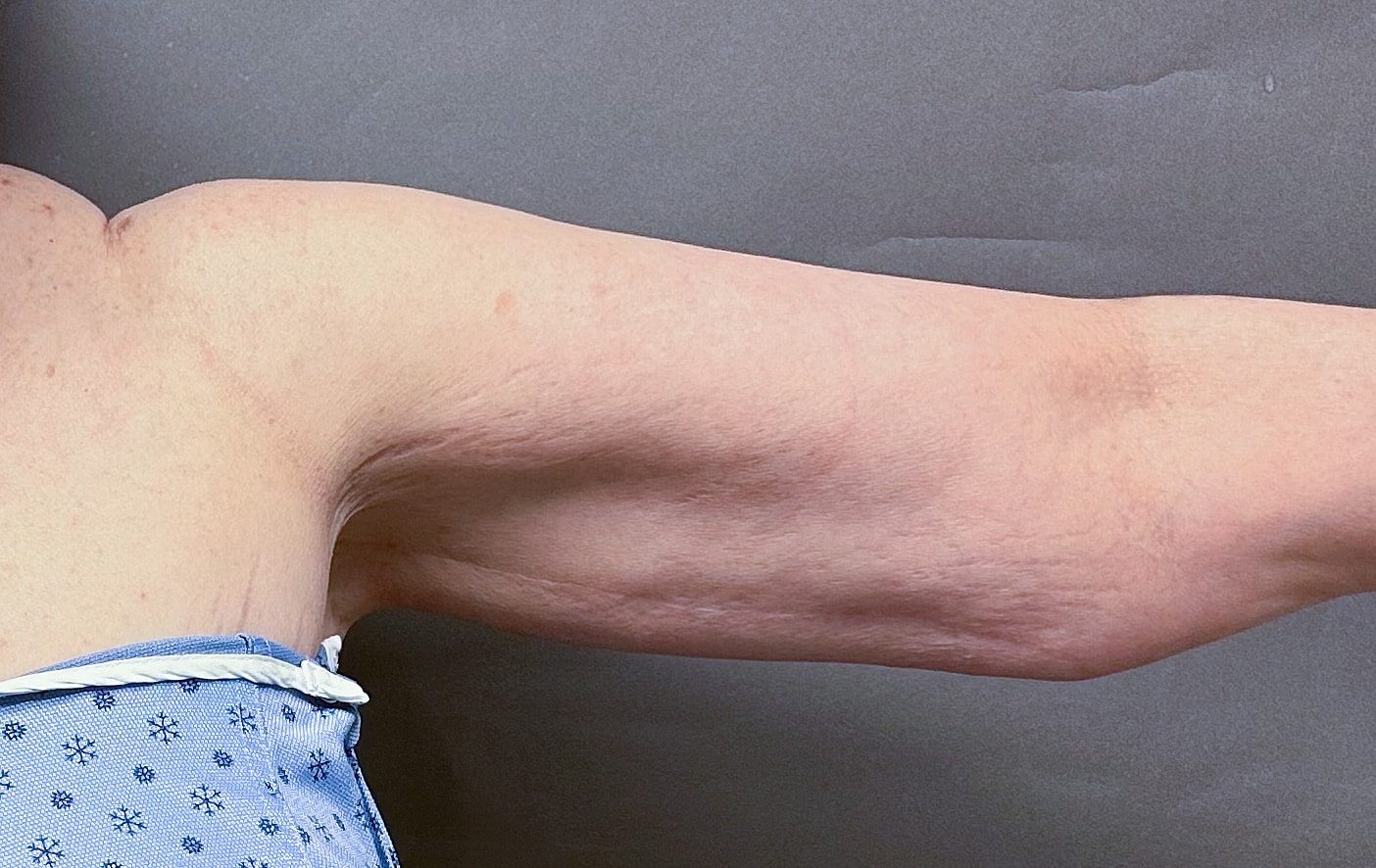 Brachioplasty Before & After