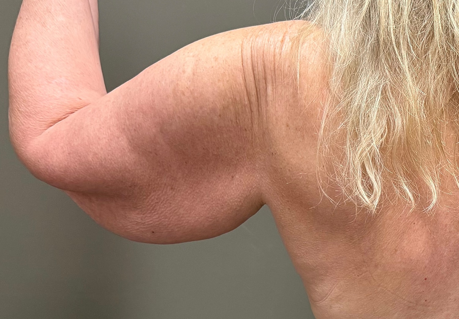 Brachioplasty Before & After