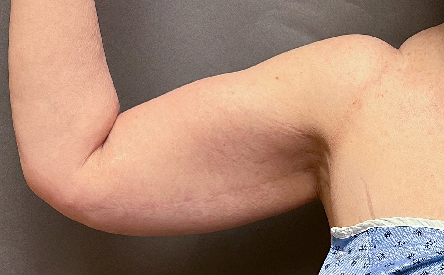 Brachioplasty Before & After