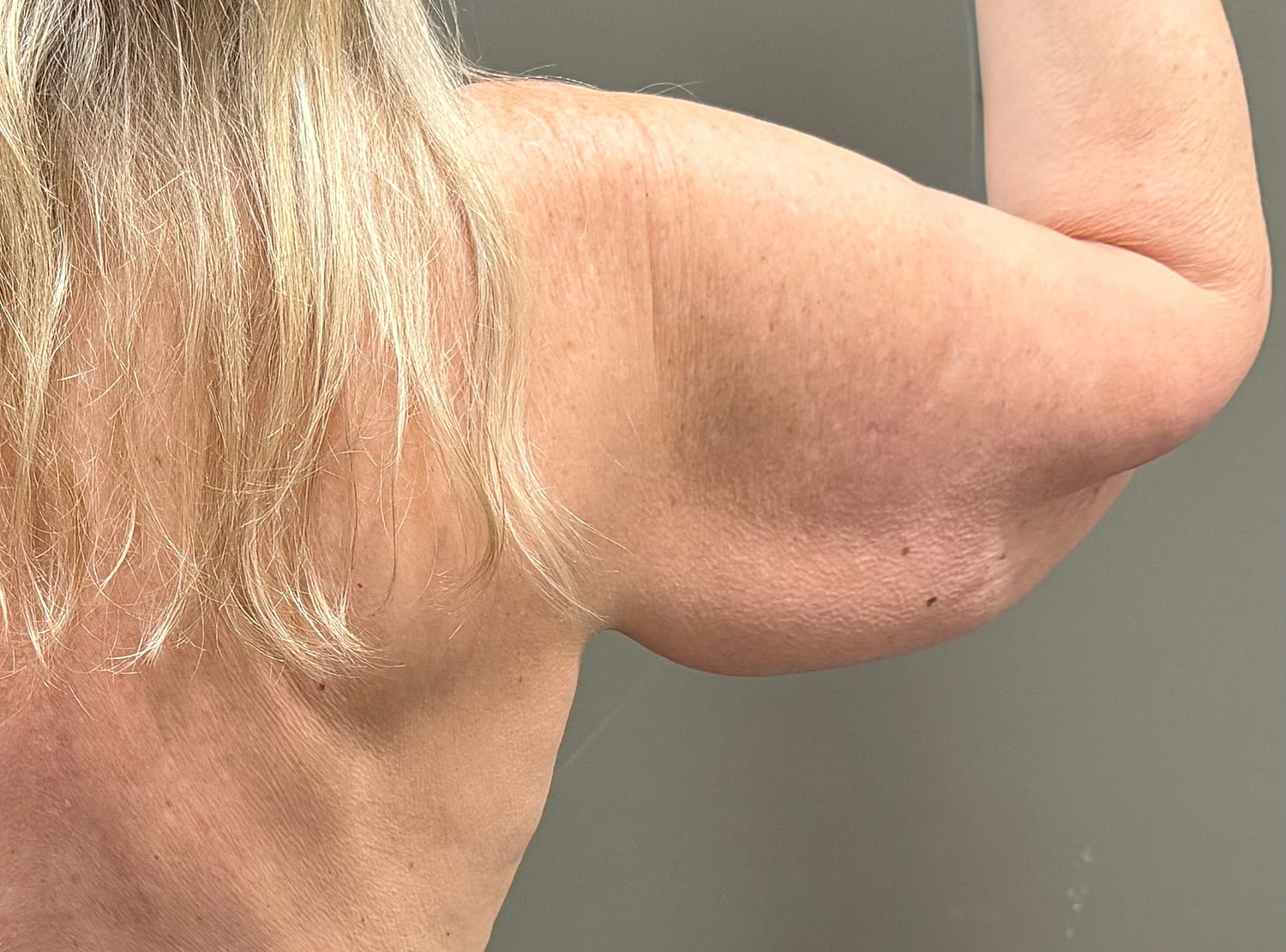 Brachioplasty Before & After