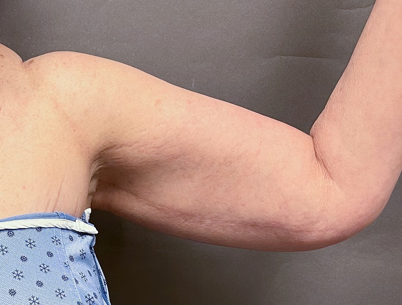 Brachioplasty Before & After