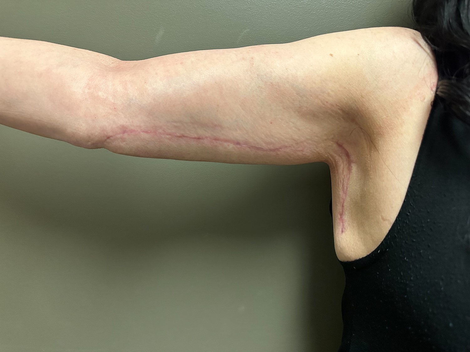 Brachioplasty Before & After