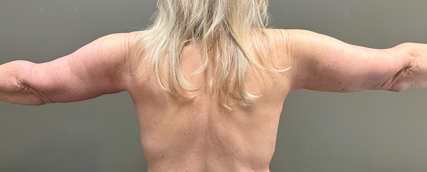 Brachioplasty Before & After