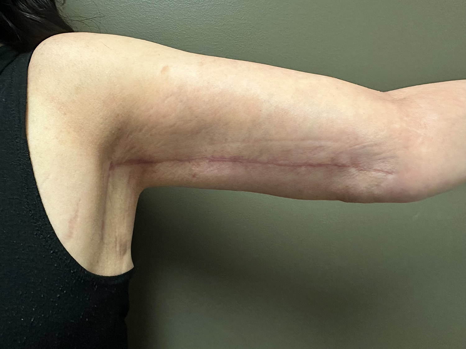 Brachioplasty Before & After