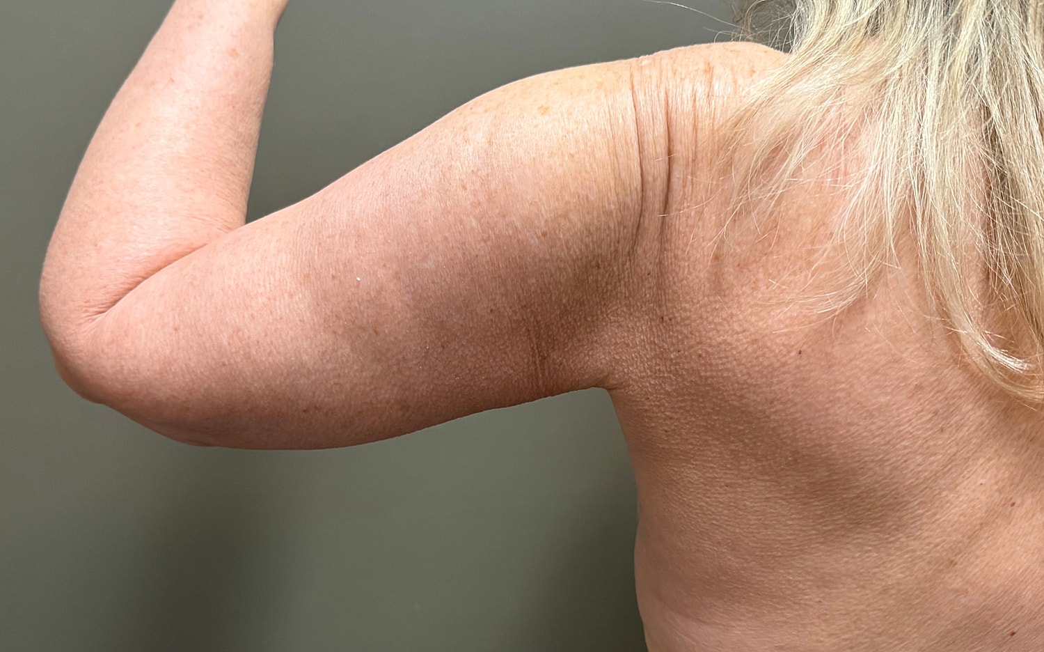 Brachioplasty Before & After
