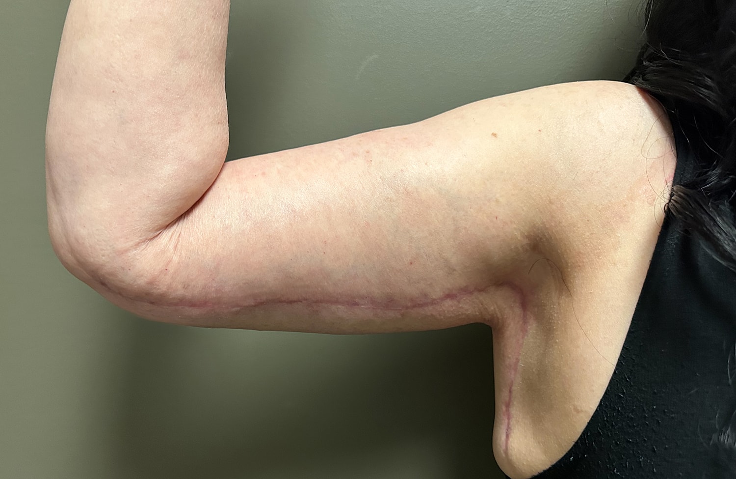 Brachioplasty Before & After