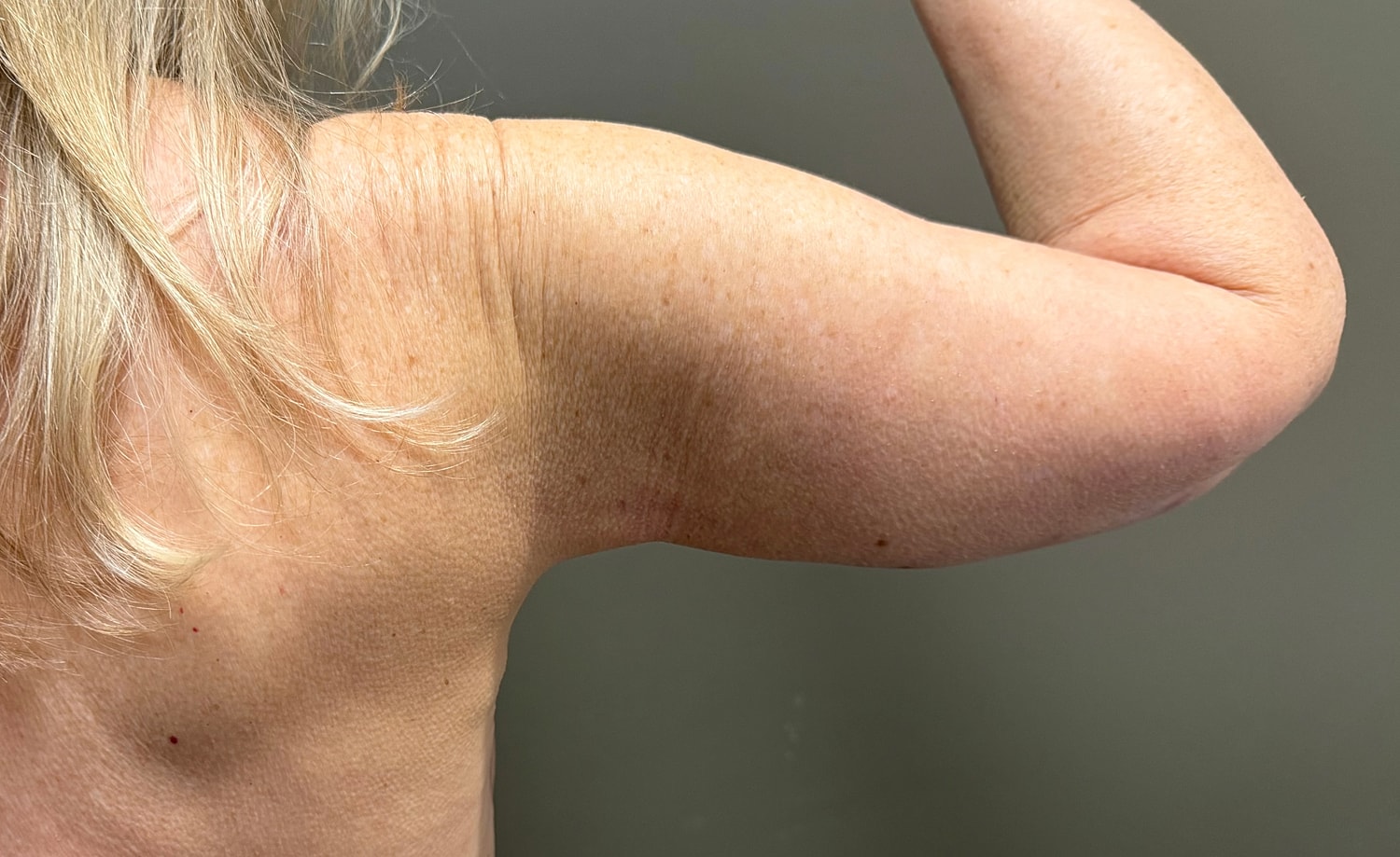 Brachioplasty Before & After