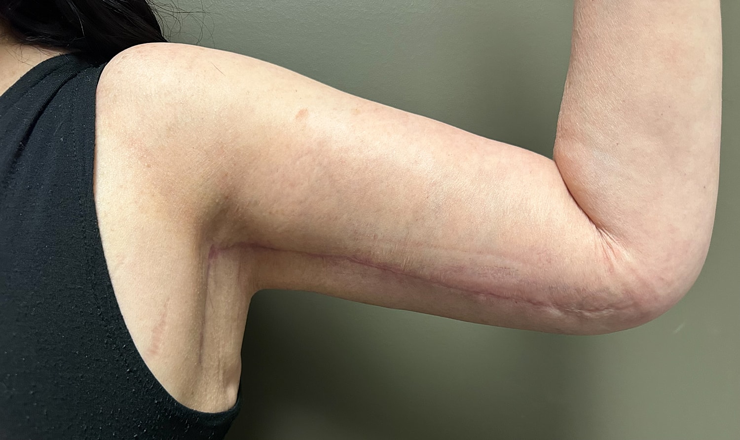 Brachioplasty Before & After