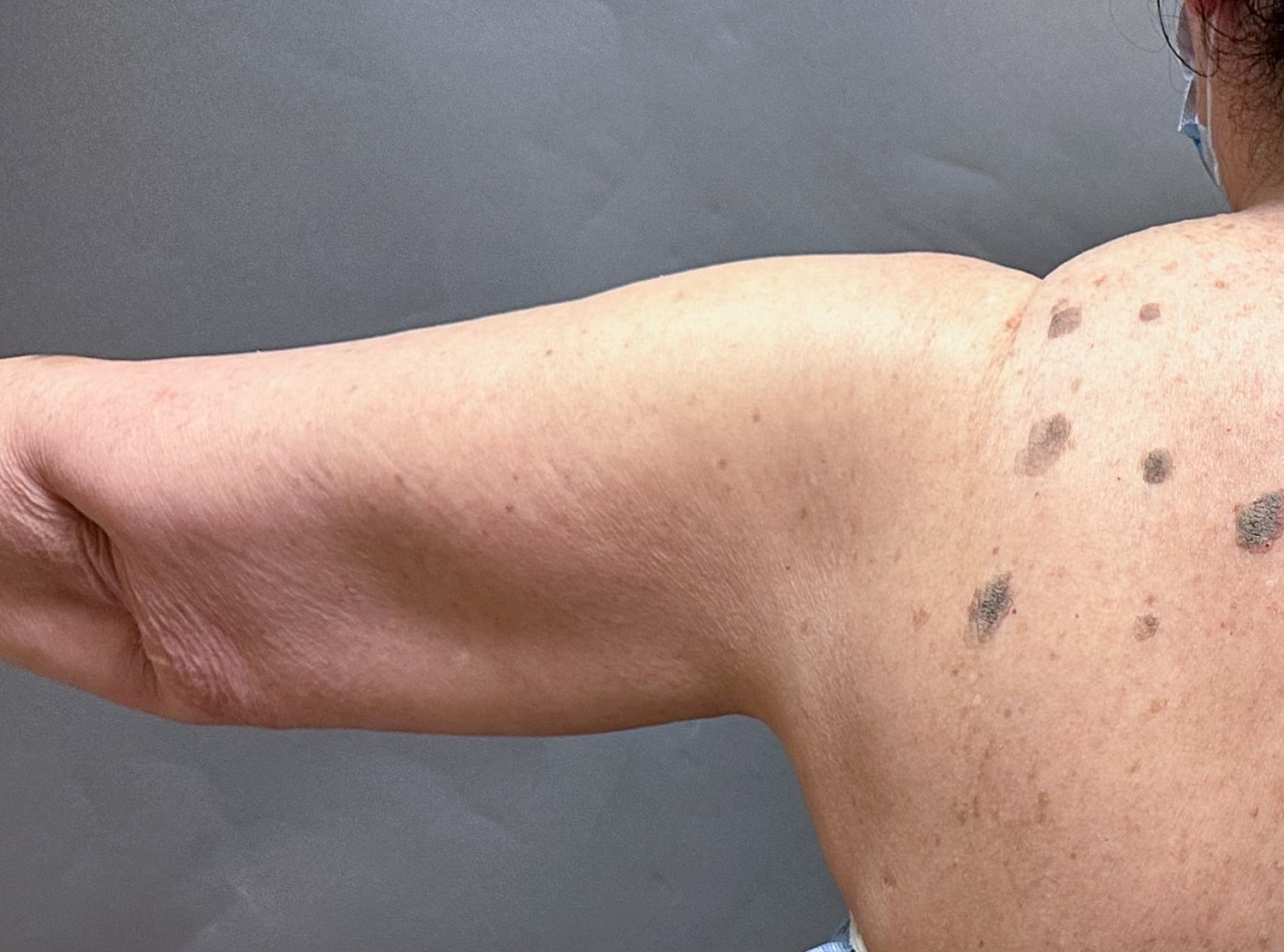 Brachioplasty Before & After