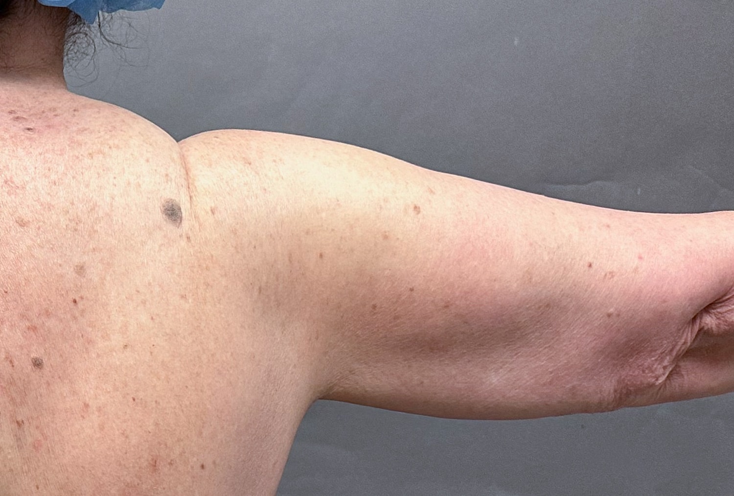 Brachioplasty Before & After