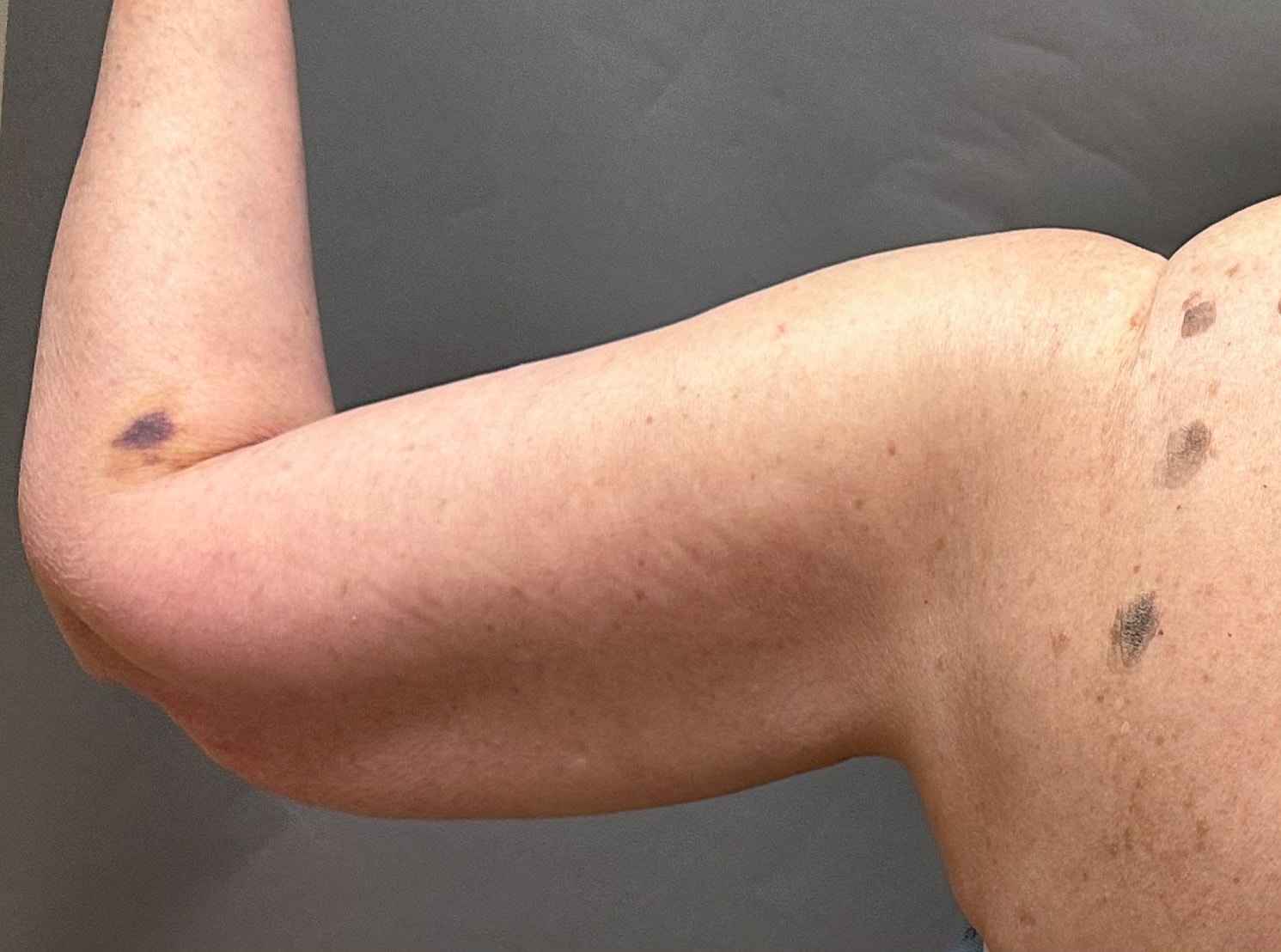 Brachioplasty Before & After