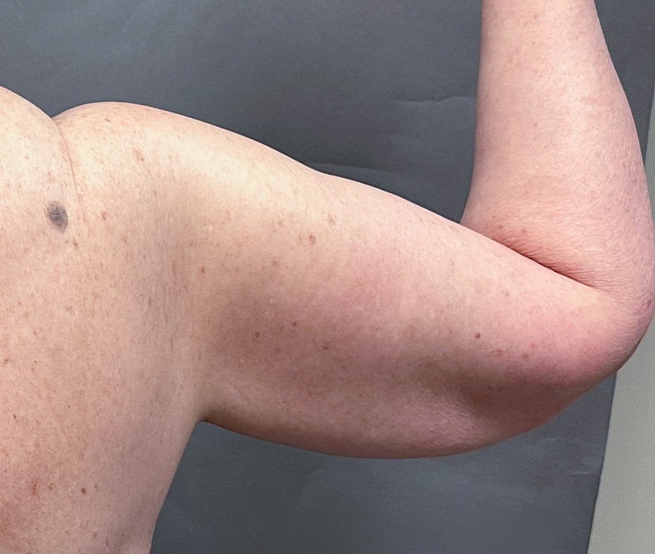 Brachioplasty Before & After