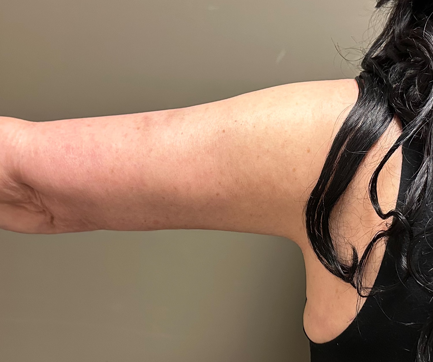 Brachioplasty Before & After