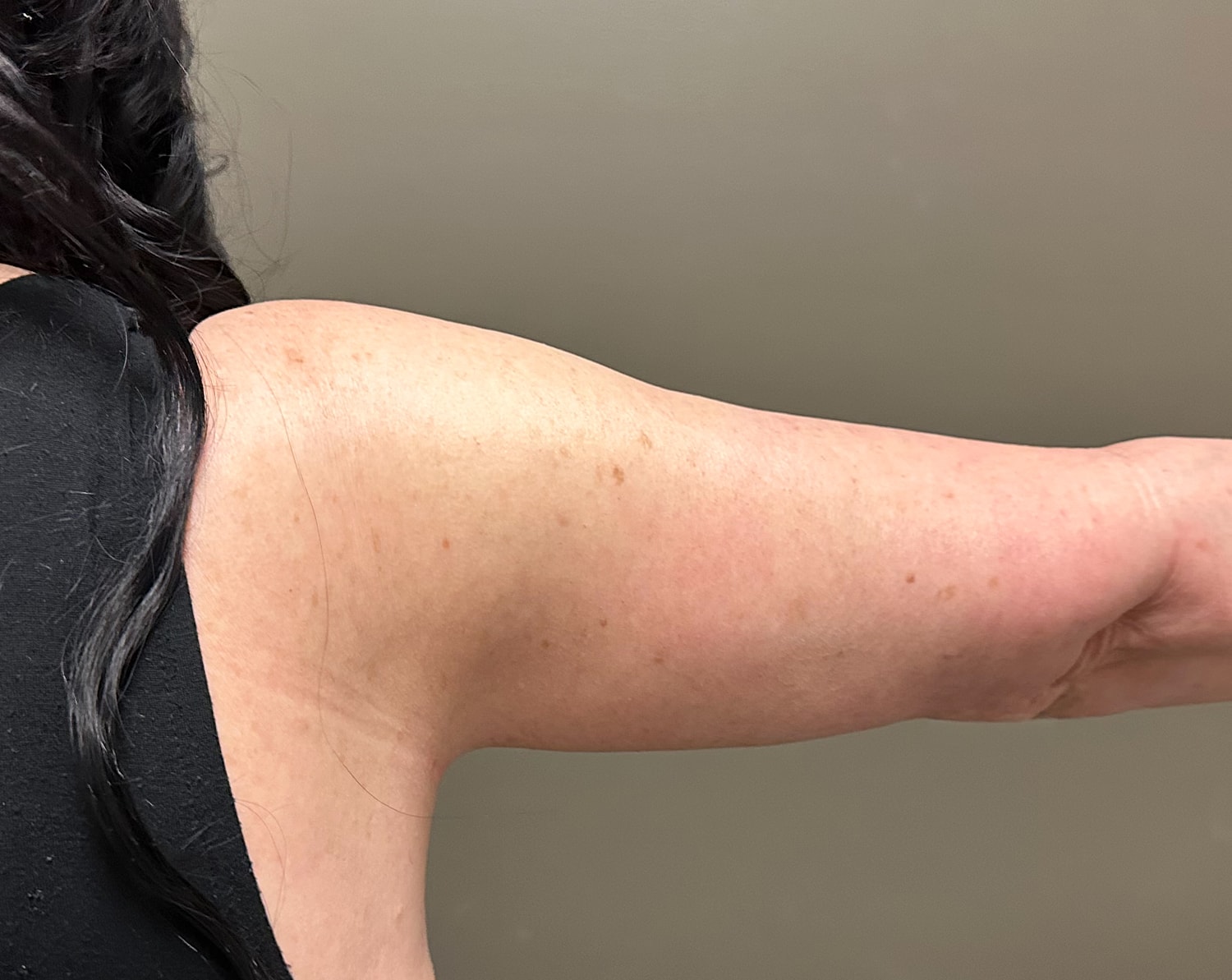 Brachioplasty Before & After