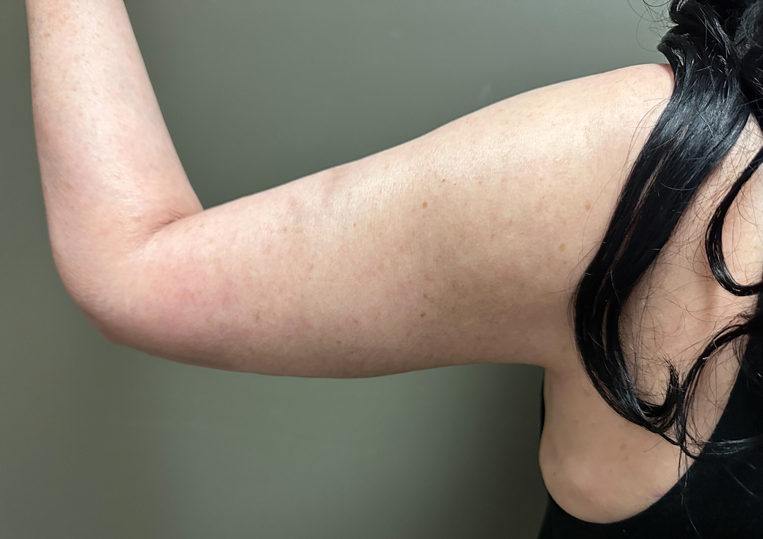 Brachioplasty Before & After