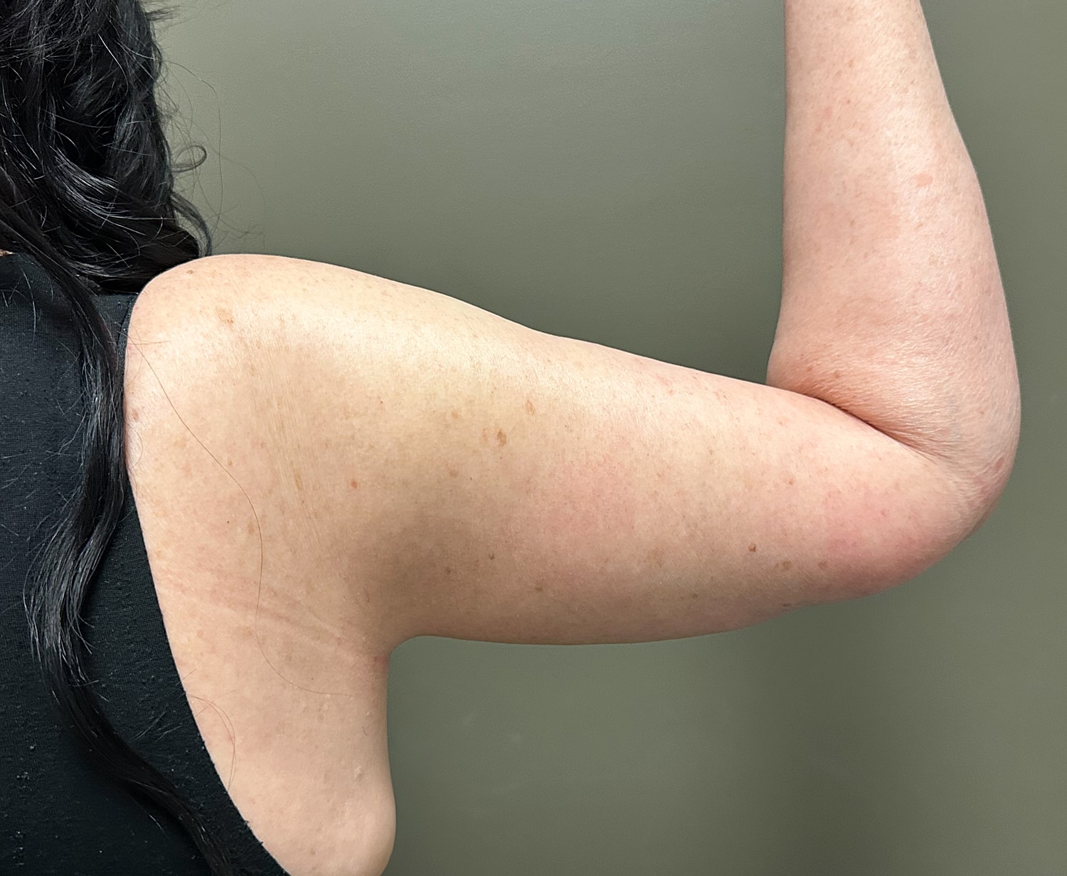 Brachioplasty Before & After