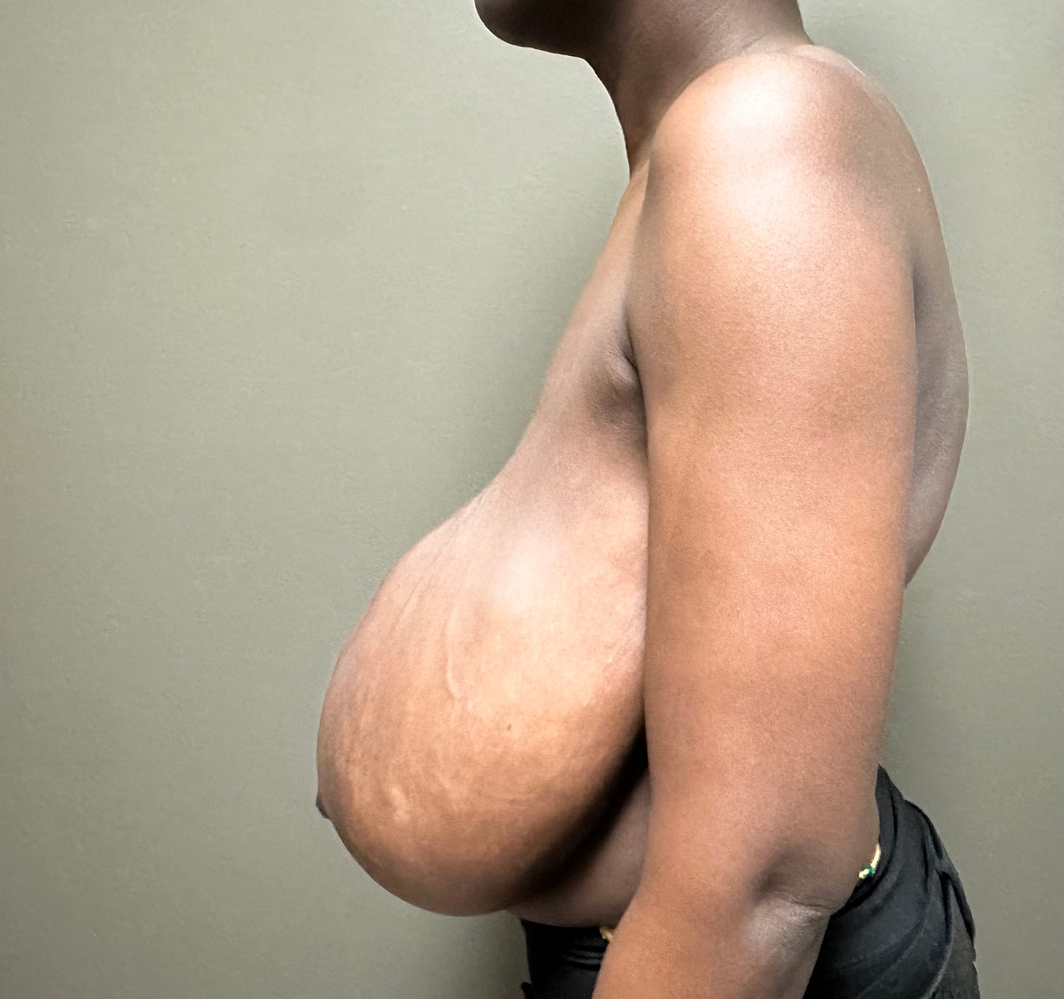 Breast Reduction with Lift Before & After