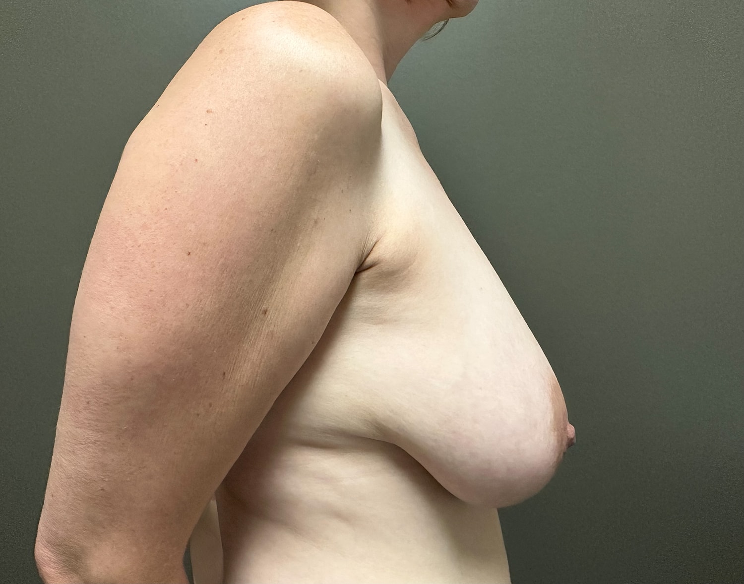 Breast Reduction with Lift Before & After
