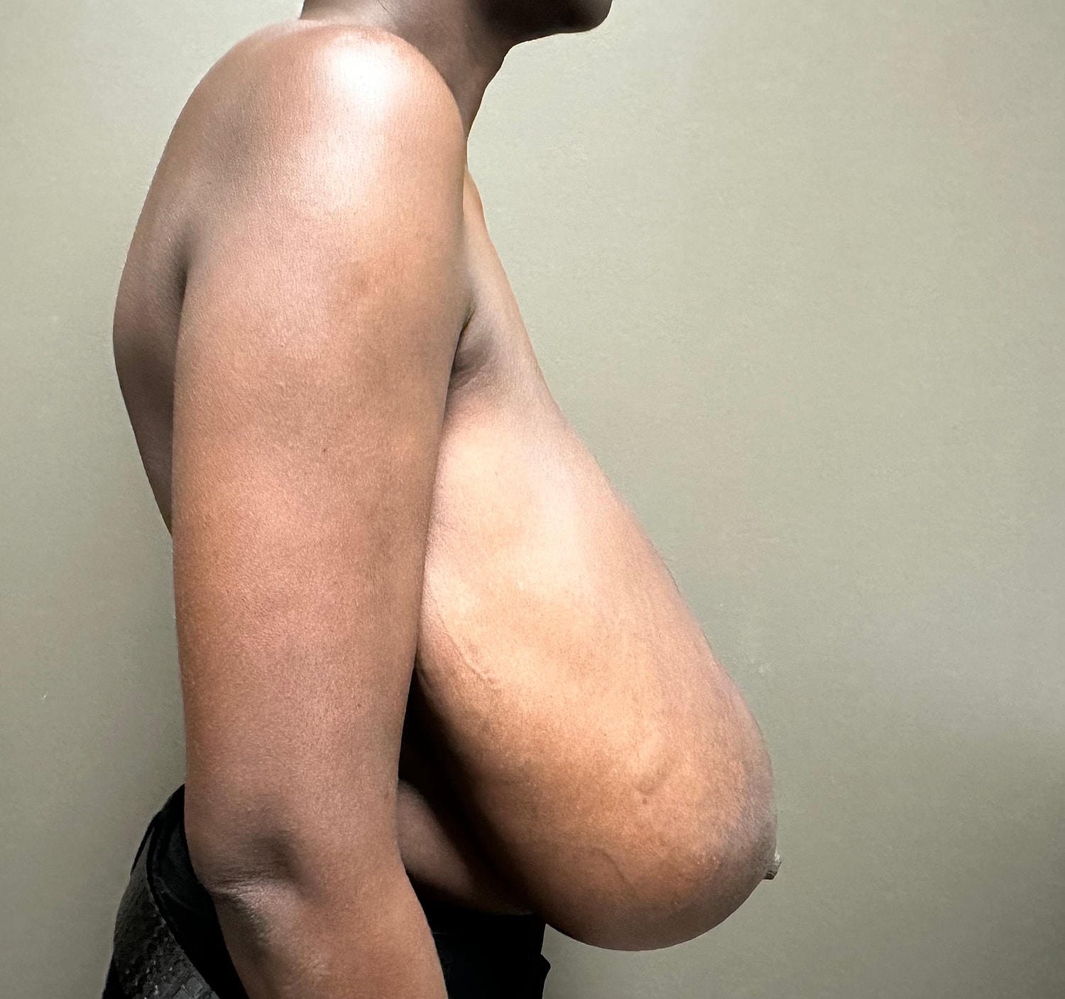 Breast Reduction with Lift Before & After