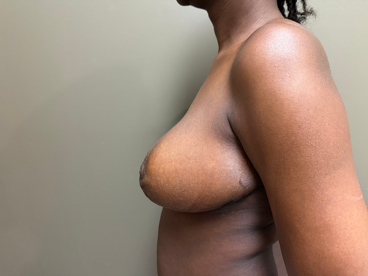 Breast Reduction with Lift Before & After