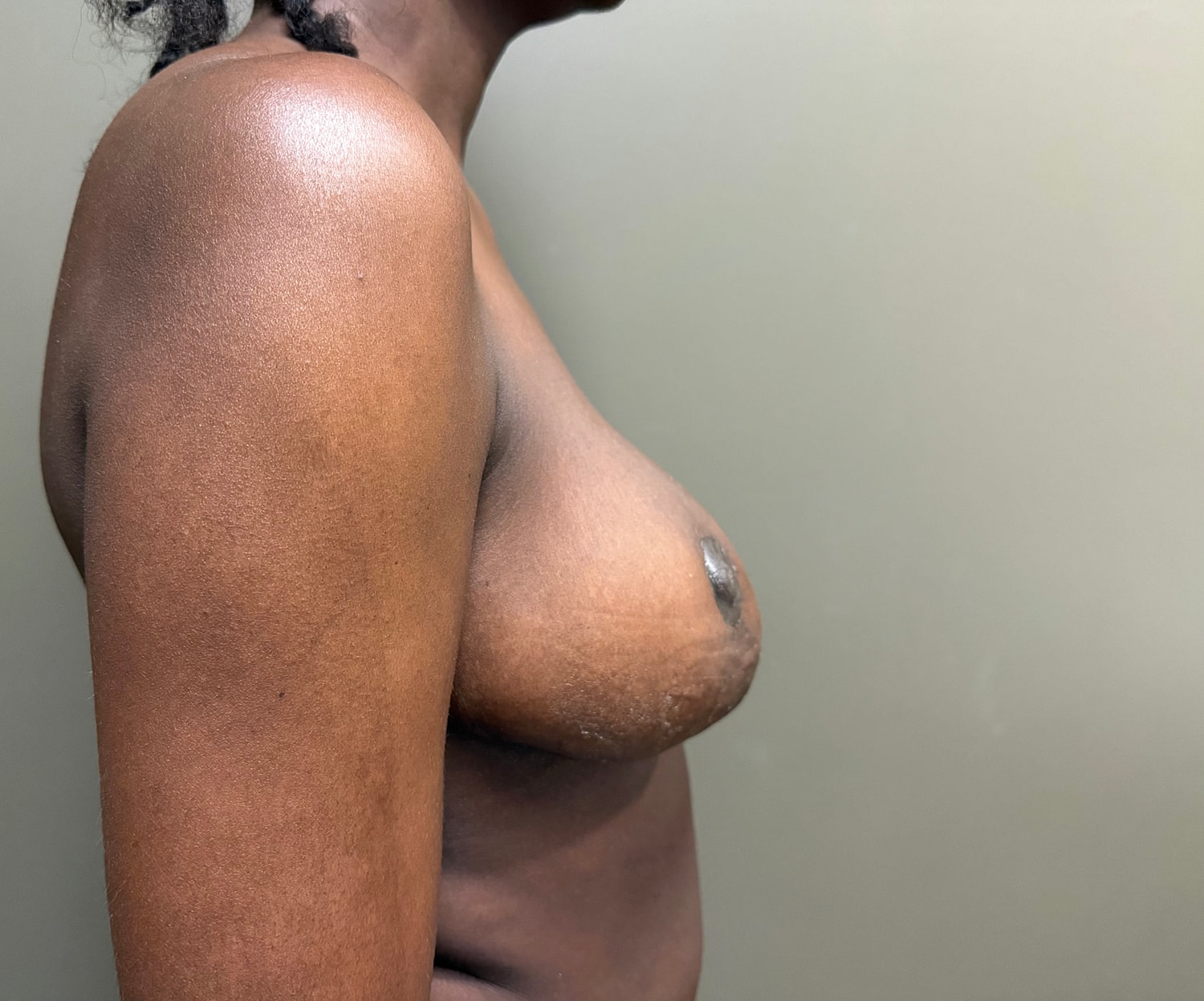 Breast Reduction with Lift Before & After