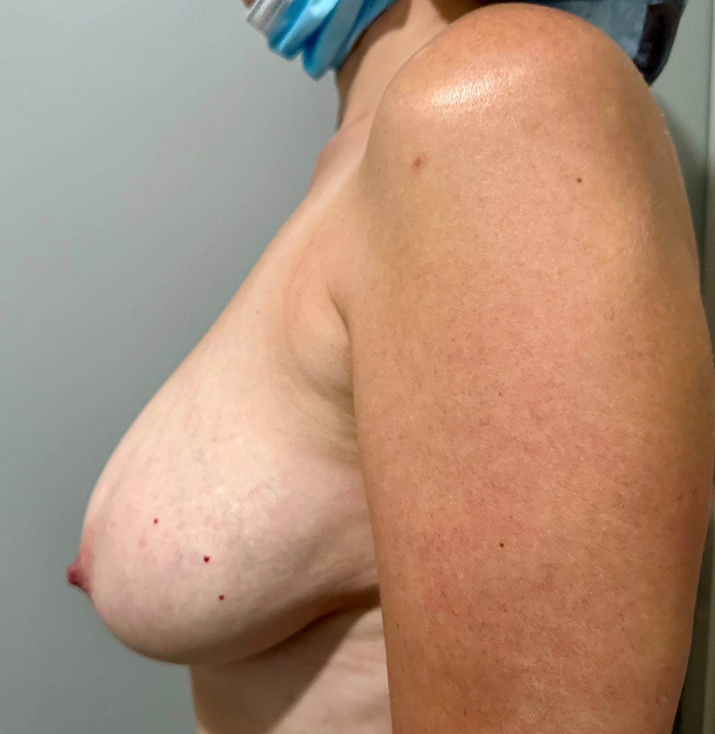 Breast Reduction with Lift Before & After