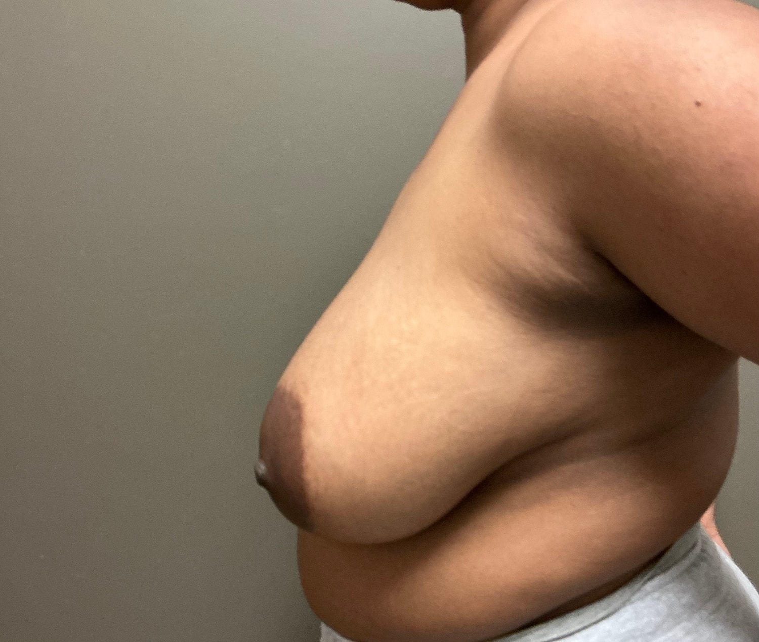 Breast Reduction with Lift Before & After