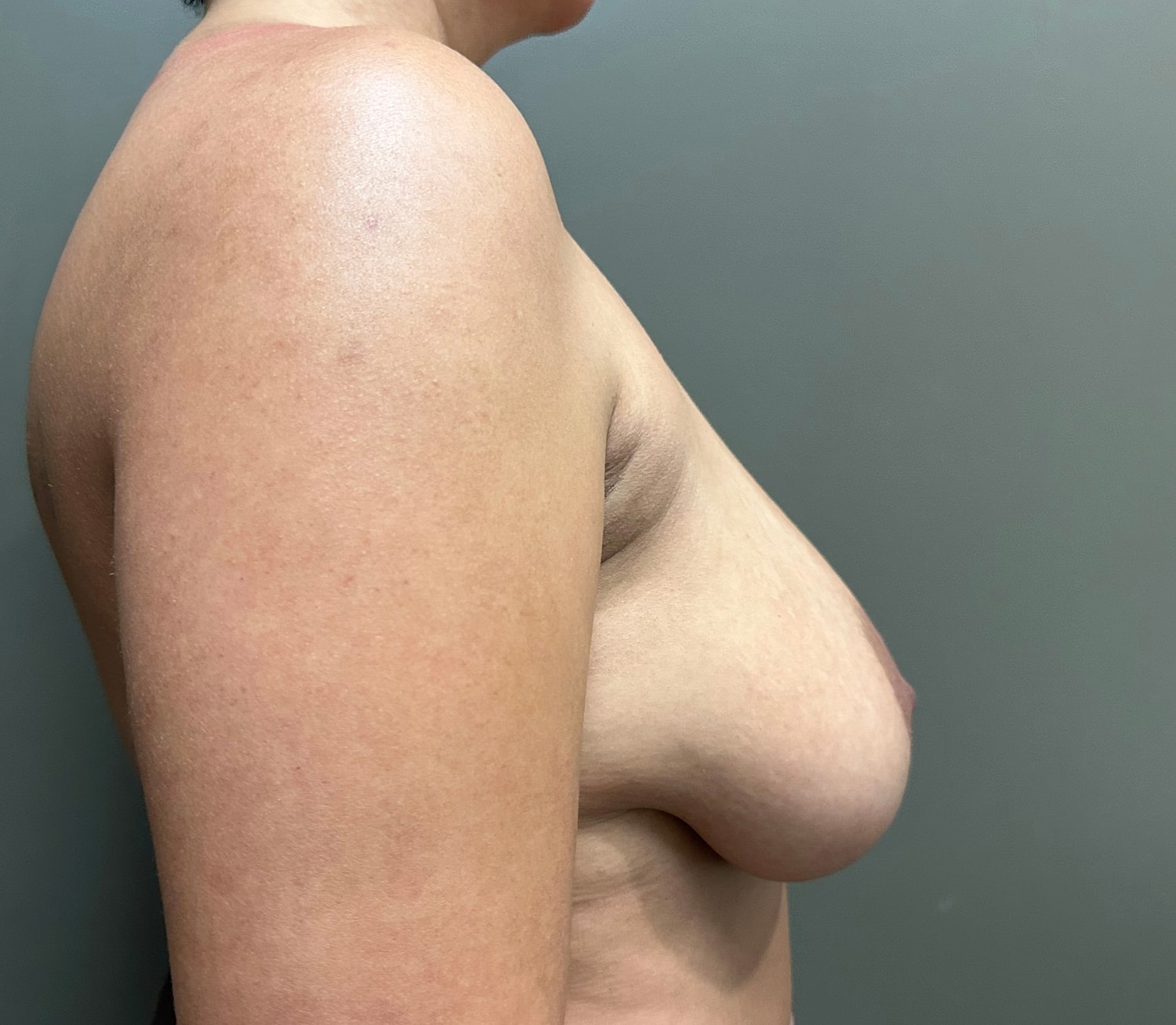 Breast Reduction with Lift Before & After