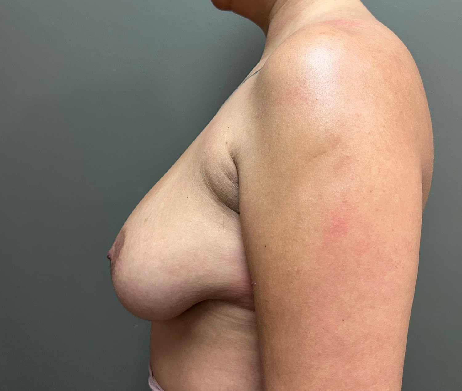Breast Reduction with Lift Before & After