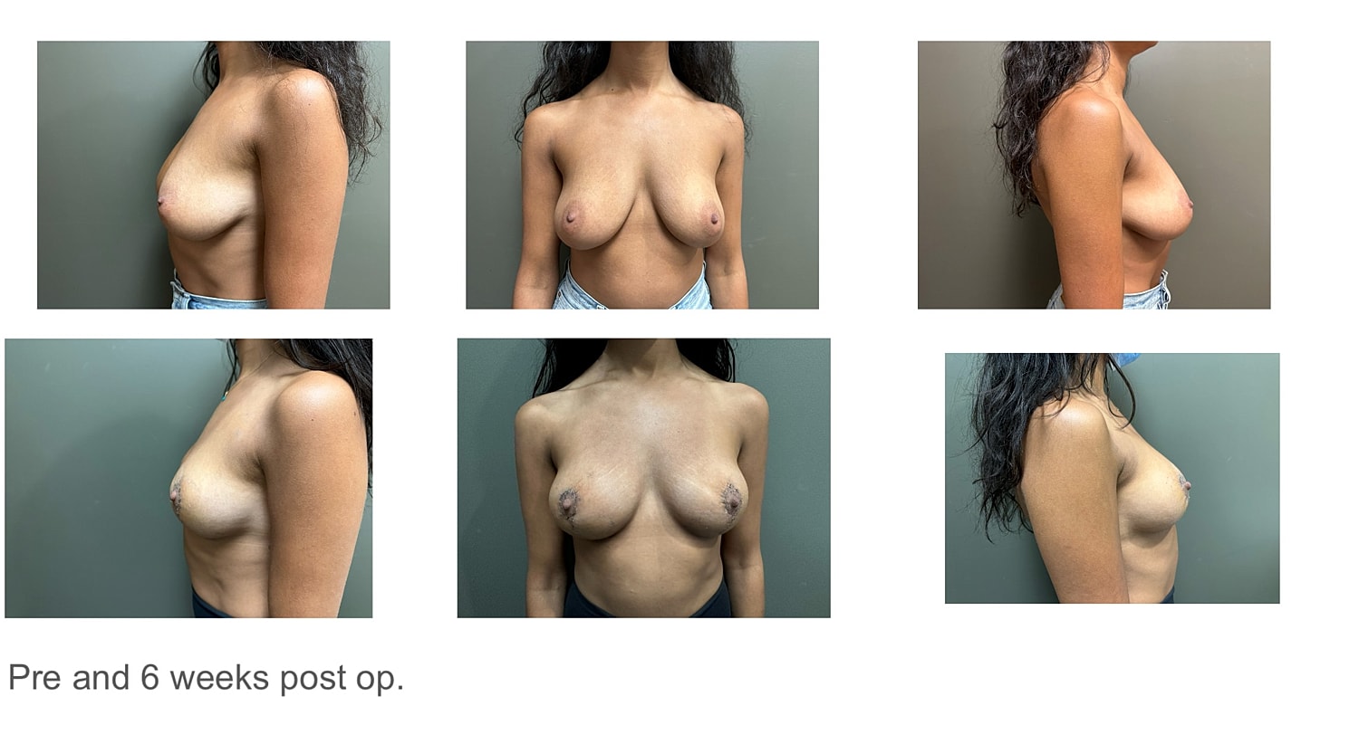 Breast Reduction with Lift Before & After