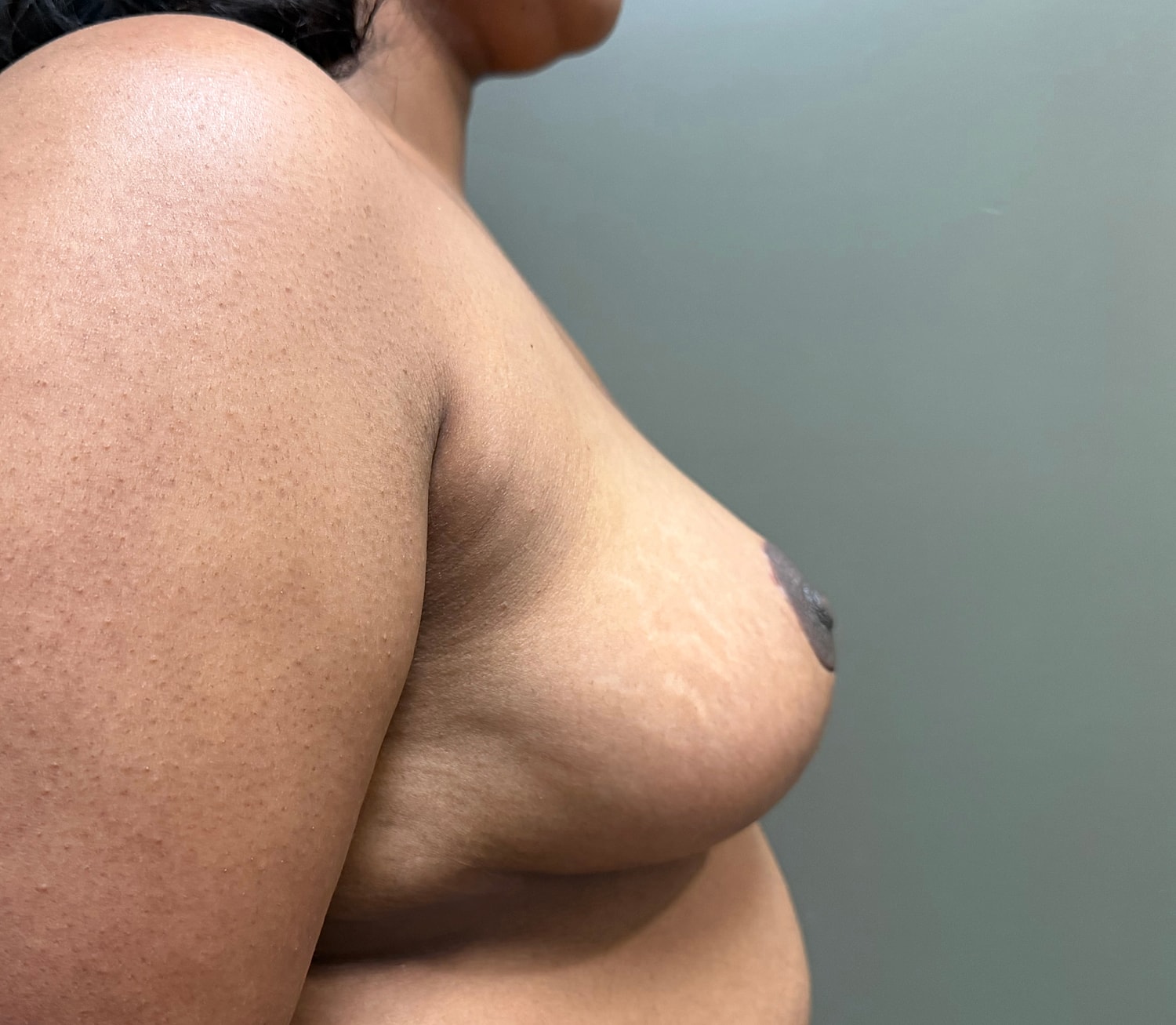 Breast Reduction with Lift Before & After