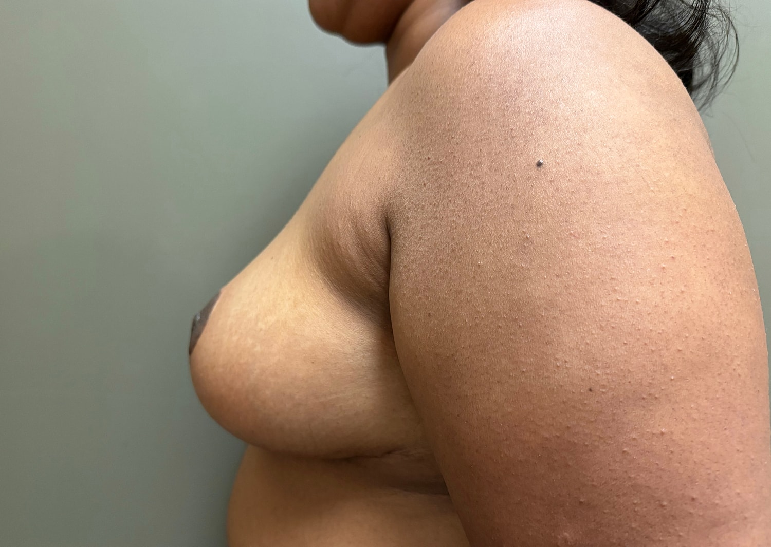 Breast Reduction with Lift Before & After