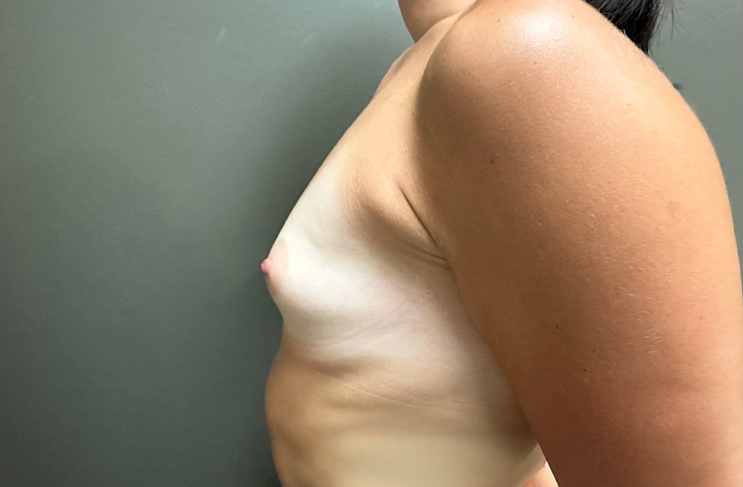 Breast Augmentation Before & After