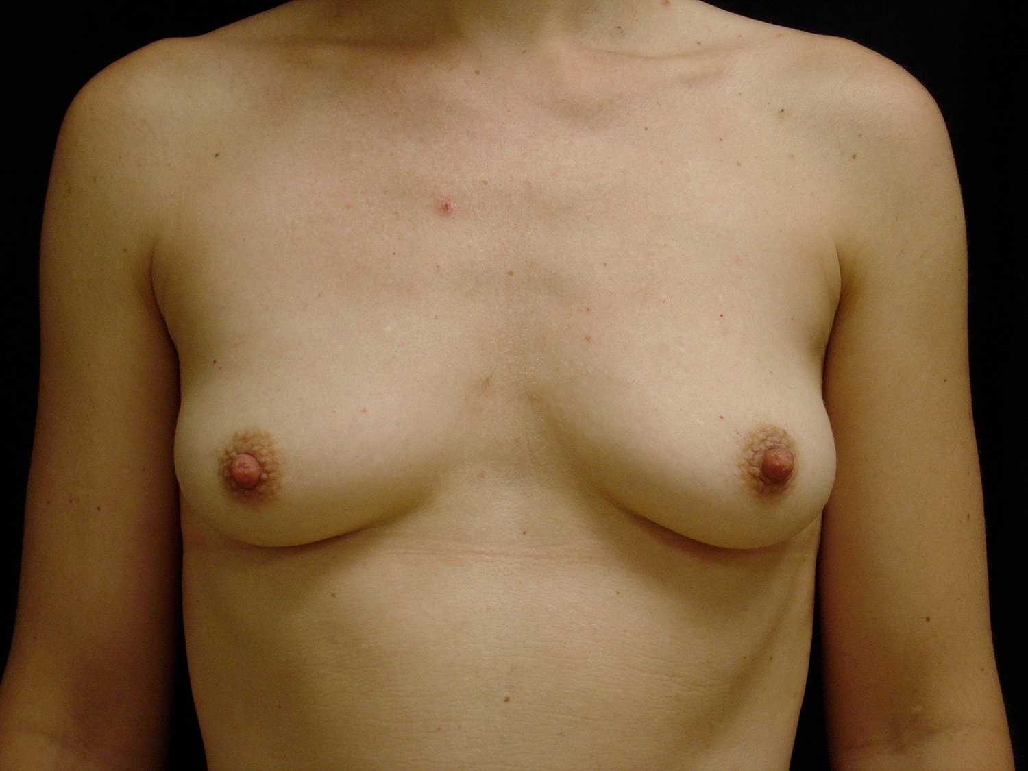 Breast Augmentation Before & After