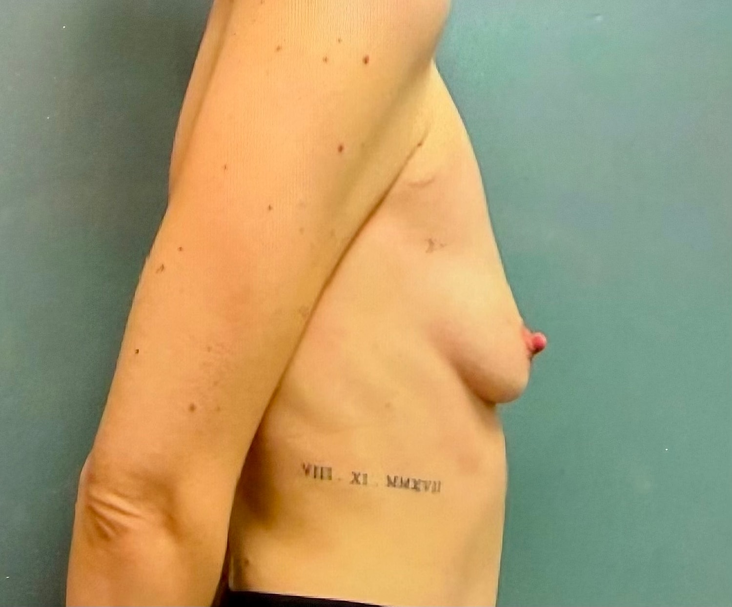 Breast Augmentation Before & After