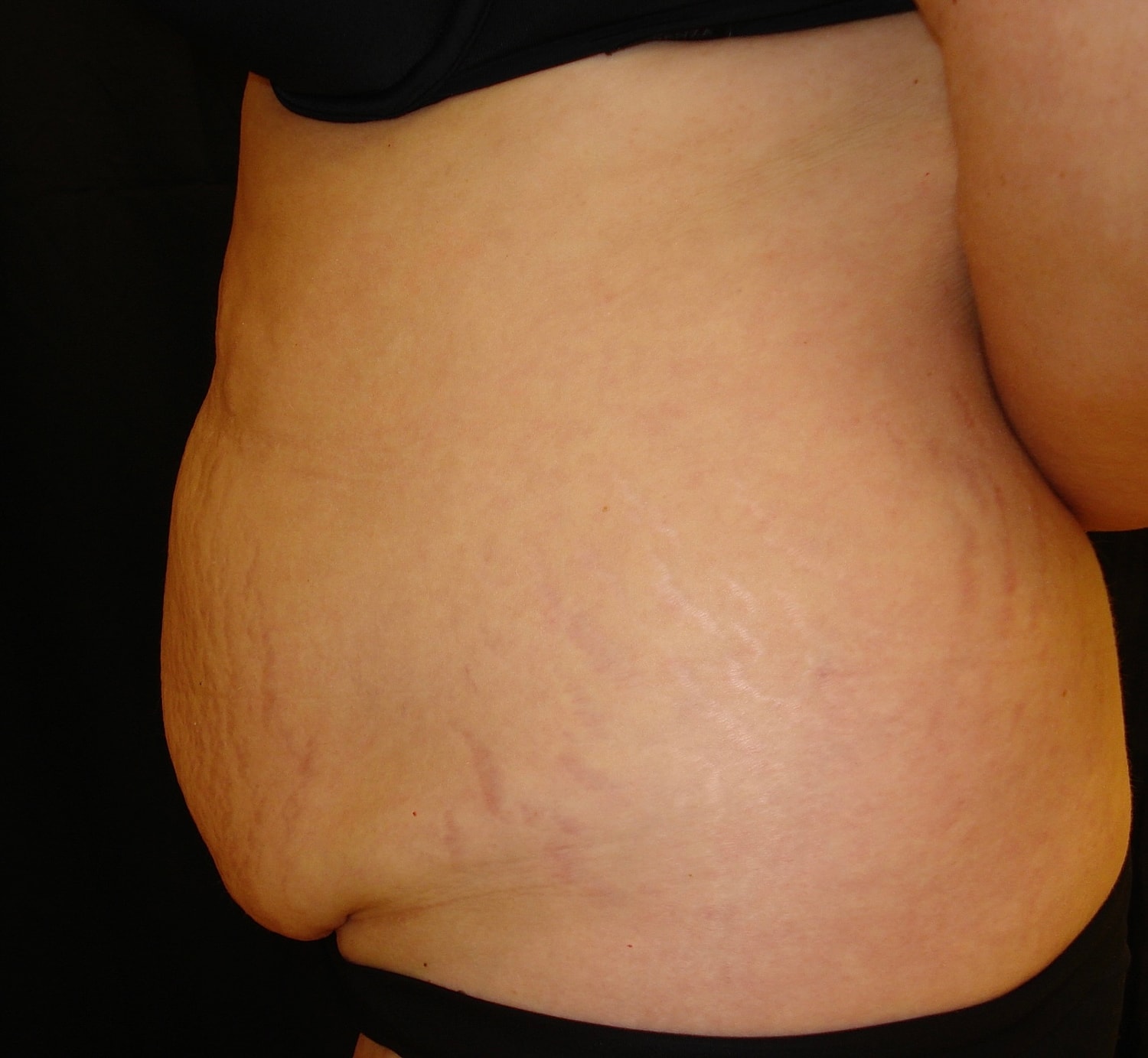 Abdominoplasty Before & After