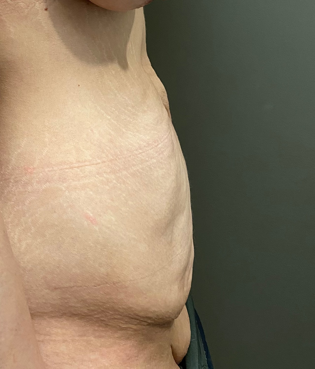 Abdominoplasty Before & After