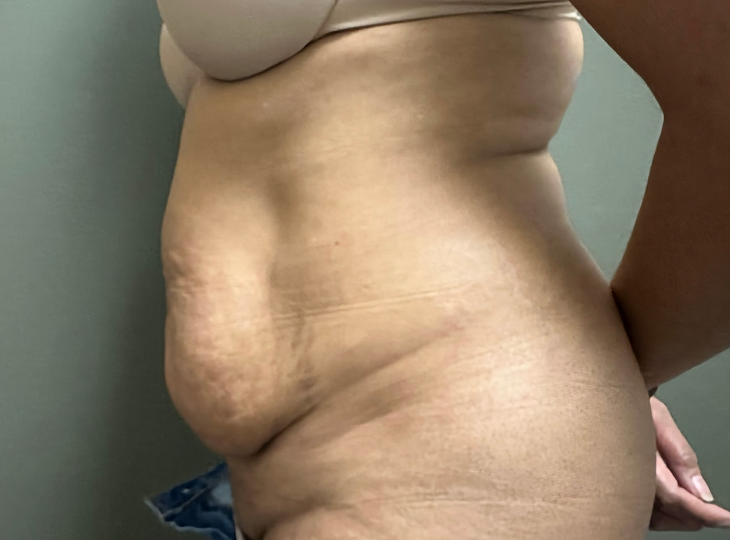 Abdominoplasty Before & After