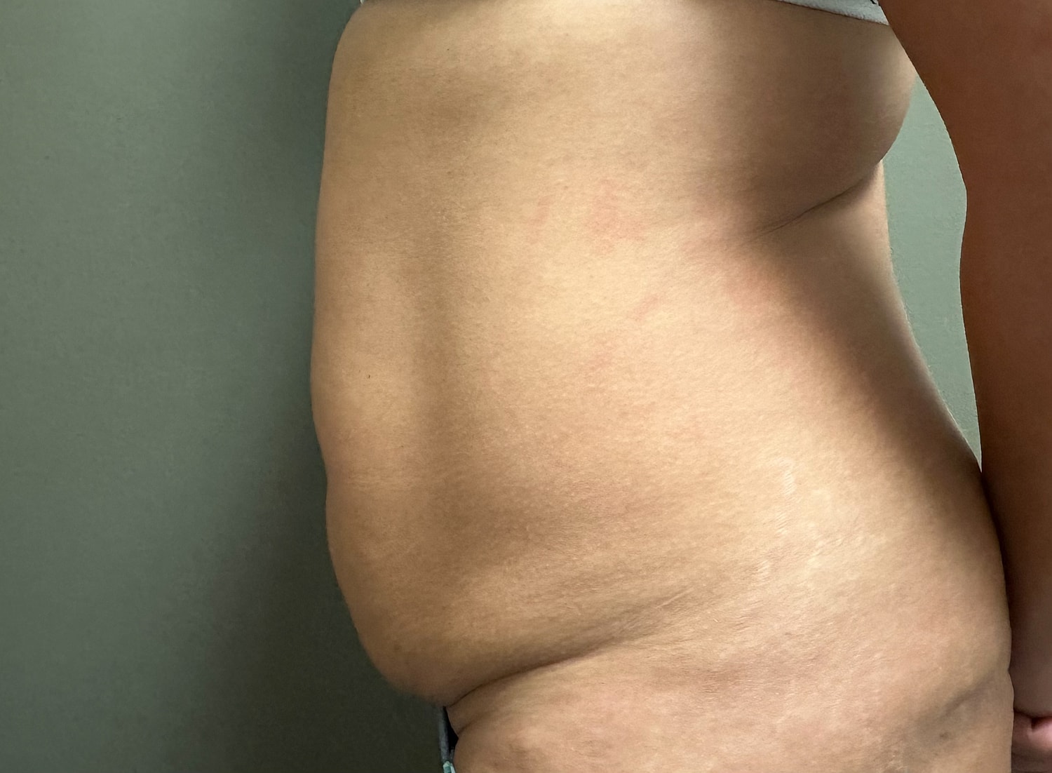 Abdominoplasty Before & After