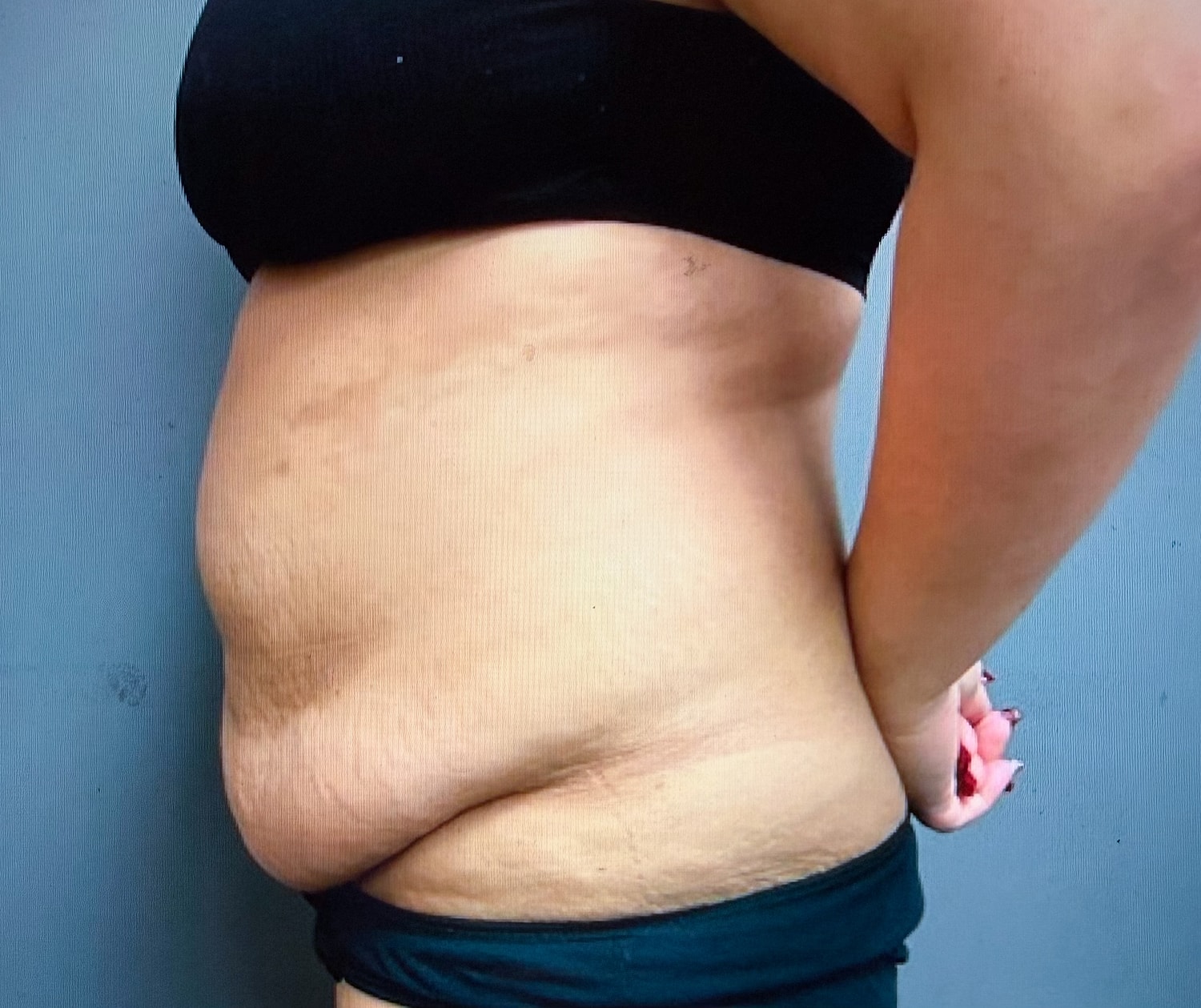 Abdominoplasty Before & After