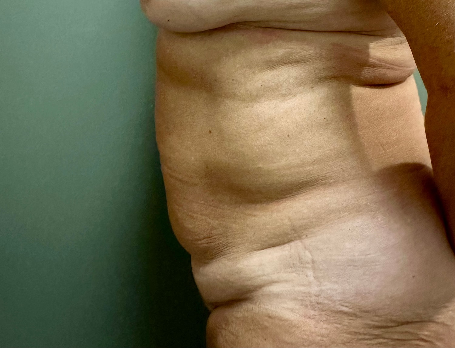 Abdominoplasty Before & After