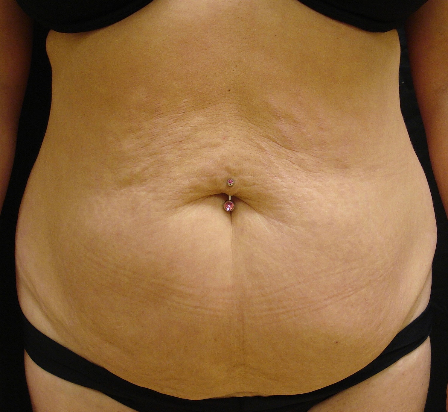 Abdominoplasty Before & After